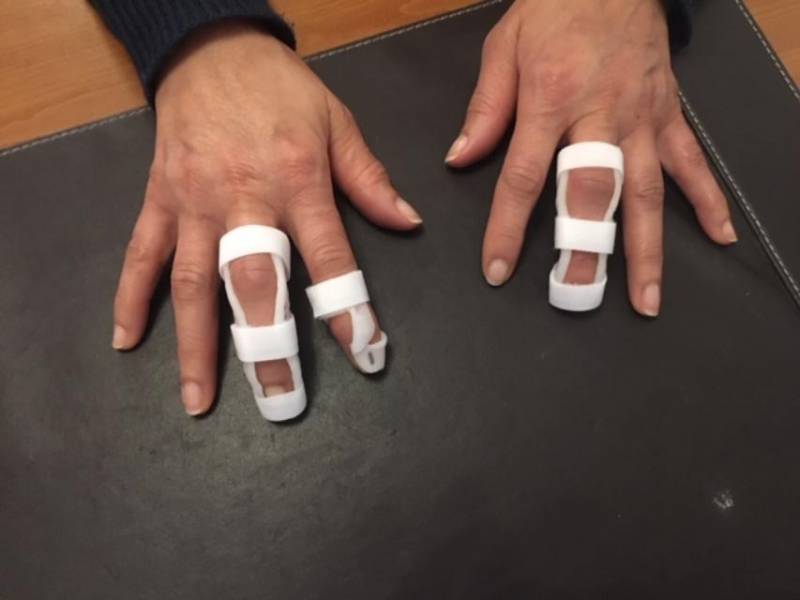 Réalisation d’orthèses digitales thermoformées pour douleurs et déformations des doigts Arthrose à Allauch