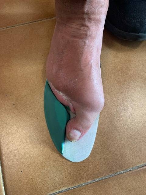 Pied diabétique, semelles orthopédiques pour amputation partielle du pied réalisées sur mesure à Marseille