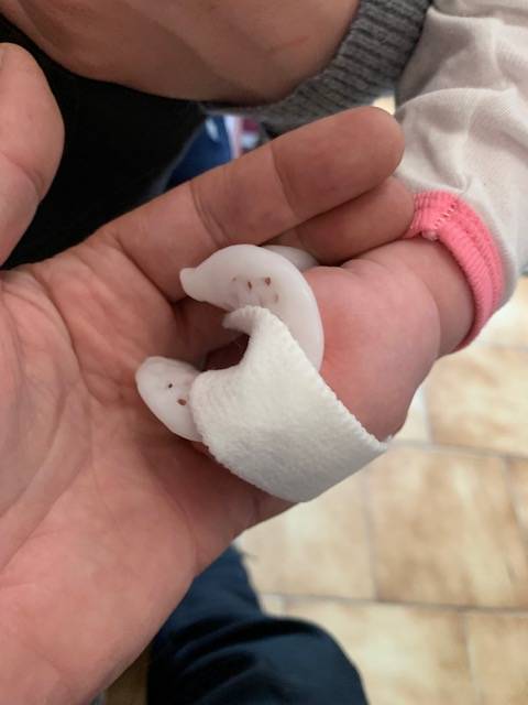 Orthèse thermoformée pédiatrique pour pouce adductus chez un bébé de six mois, fabriquée sur mesure à Marseille