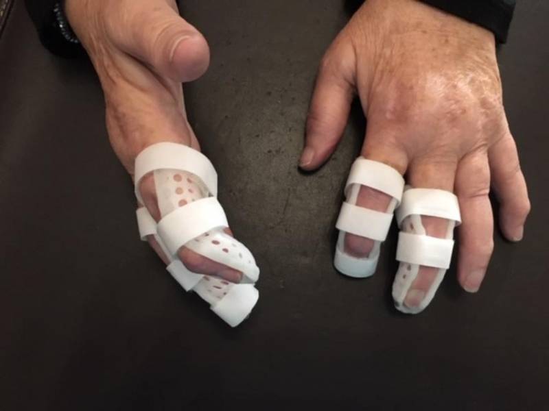 Orthèses digitales thermoformées pour doigts en maillet (Mallet Finger) Polyarthrite Rhumatoïde Marseille