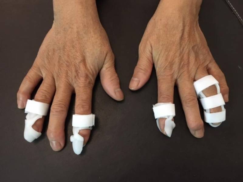 Comment soulager l’arthrose des doigts ? Comment éviter les déformations des doigts liées à l’arthrose ? Orthèses / attelles thermoformées digitales à Allauch, proche de Saint Barnabé
