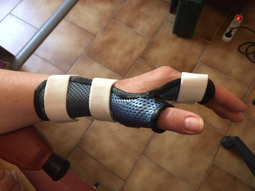 Orthèse thermoformée du poignet pour syndrome du canal carpien à Allauch proche de Saint Barnabé 13012.