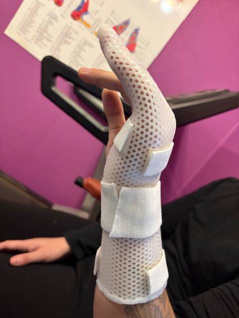 Orthèse thermoformée pour fracture du cinquième métacarpien réalisée sur moulage à Allauch