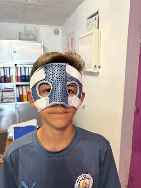 Orthèse nasale sur mesure : protéger le nez après une fracture et sécuriser la reprise du sport - réalisation dans notre cabinet à Allauch (13011 13012 13013)