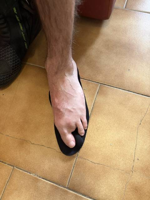 Réalisation de semelles orthopédiques après amputation des orteils à Allauch pour soulager les douleurs du pied