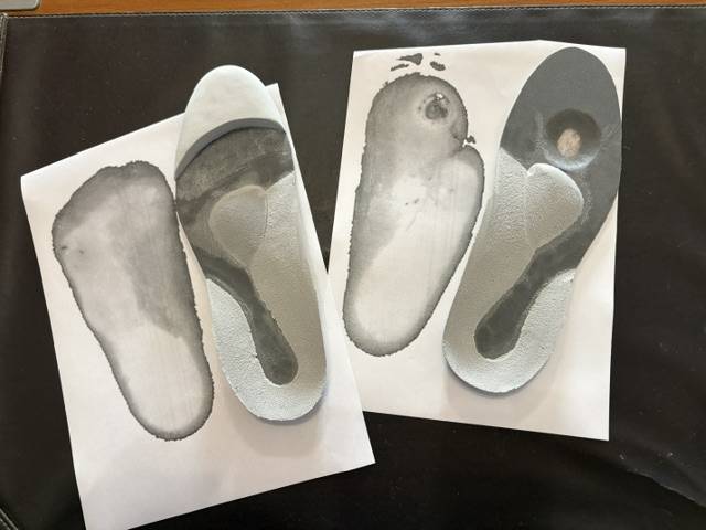 Semelles orthopédiques sur mesure pour pied diabétique : traitement du mal perforant plantaire et prévention de l'amputation