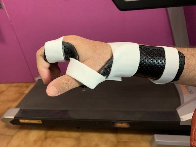 Orthèse thermoformée pour syndrome du canal carpien réalisé par Orthésiste à Allauch