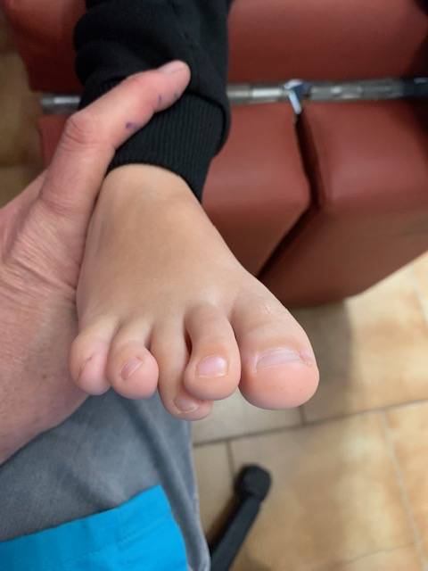 Orthoplastie en silicone pour corriger les orteils déformés chez l’enfant à Allauch et Marseille