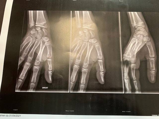 Prendre en charge la traumatologie pédiatrique avec orthèses sur mesure à Allauch et Marseille