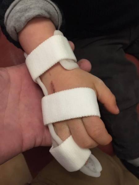 Orthopédie pédiatrique, orthèse thermoformée sur mesure pour enfant, fracture du cinquième doigt à Allauch, proche de Saint Barnabé 13012