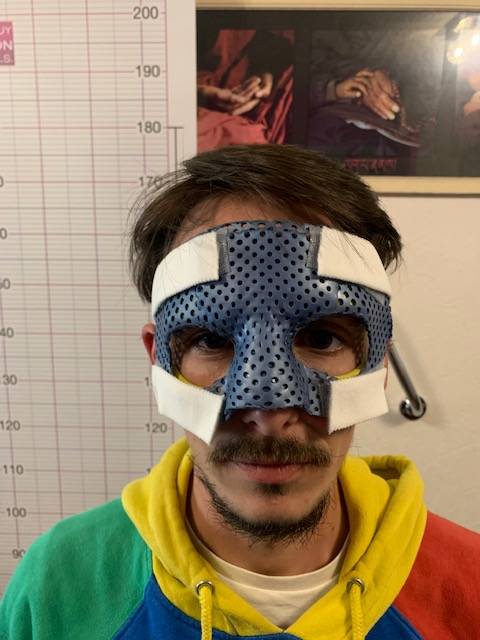 Masque de protection pour fracture du nez, orthèse faciale pour le sport, fabrication sur mesure Marseille