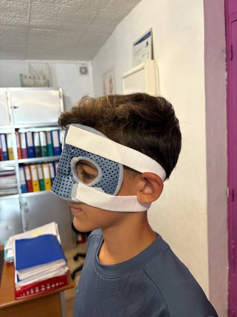 Orthèse thermoformée de protection du nez à Allauch : la solution sur mesure après une fracture nasale
