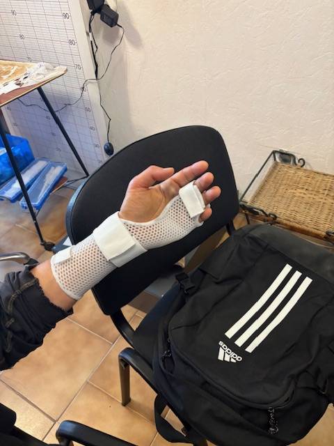 Orthèse thermoformée sur mesure pour fracture des bases des 4e et 5e métacarpiens à Allauch