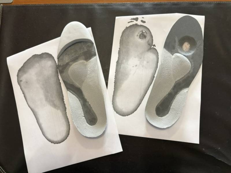 Semelles orthopédiques sur mesure pour pied diabétique : traitement du mal perforant plantaire et prévention de l'amputation