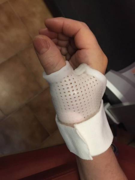 Orthèse prenant le pouce et laissant l’articulation interphalangienne libre après chirurgie de rhizarthrose, près des Trois-Lucs à Allauch