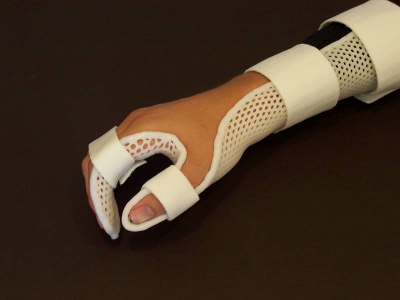 Orthèse thermoformée de la main pour Polyarthrite Rhumatoïde à Allauch