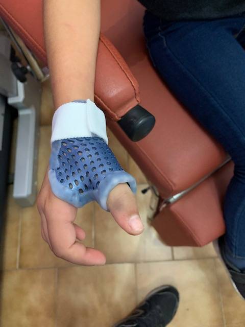 Orthopédie pédiatrique, orthèse thermoformée pour fracture Salter de type 1 du pouce, réalisées sur mesure à Marseille