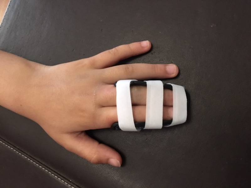 Orthèse thermoformée de mise en syndactylie de l'index et du majeur droit - Allauch