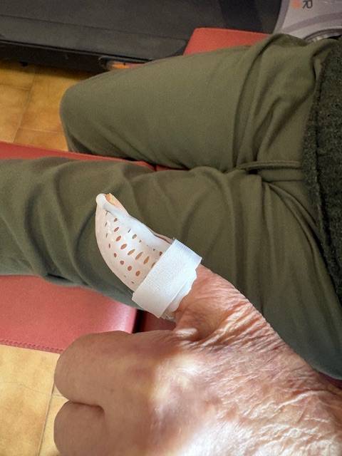 Orthèse de mise en extension de la deuxième phalange du pouce réalisée sur mesure à Allauch