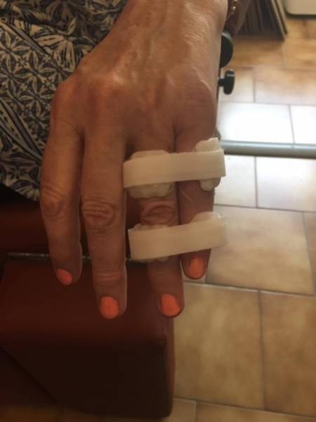 Orthèses thermoformées bagues de Syndactylie réalisées sur mesure par un orthésiste à Allauch proche de la Valentine