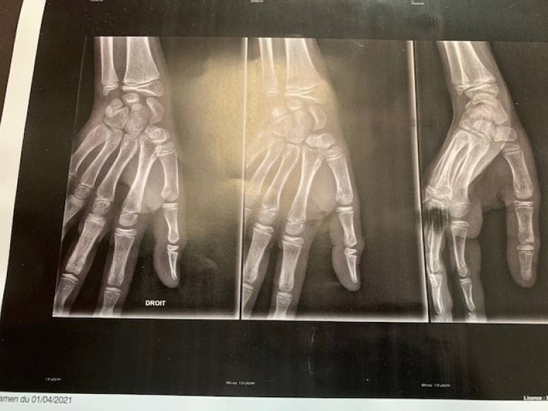 Prendre en charge la traumatologie pédiatrique avec orthèses sur mesure à Allauch et Marseille