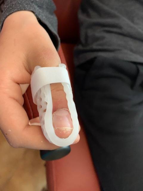 Orthèse thermoformée pour fracture de la base de la deuxième phalange du pouce réalisée sur mesure à Allauch, proche de Château Gombert