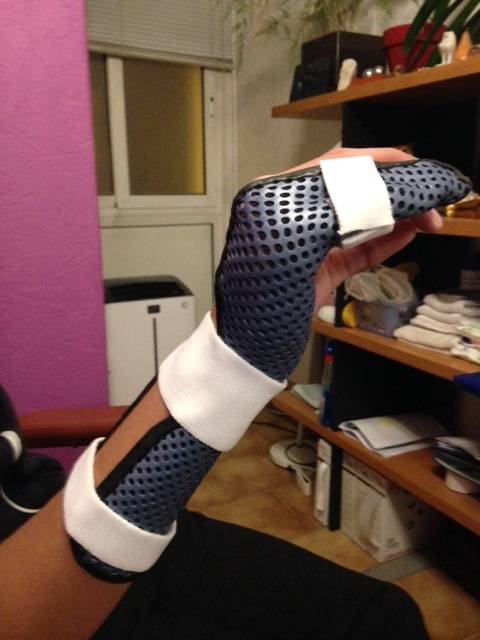 Orthèse thermoformée pour fracture du cinquième os métacarpien - Marseille