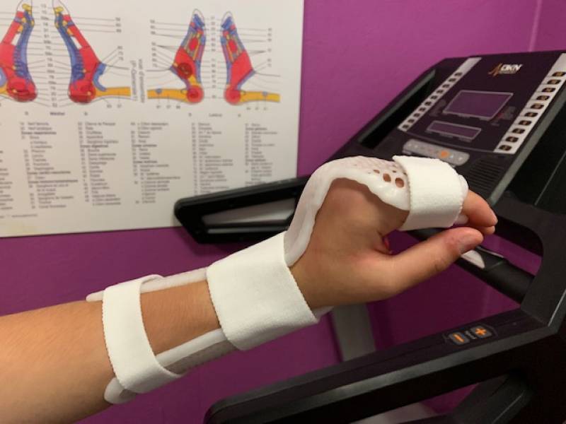 Orthèse thermoformée pour fracture du deuxième os métacarpien réalisée sur mesure à Allauch
