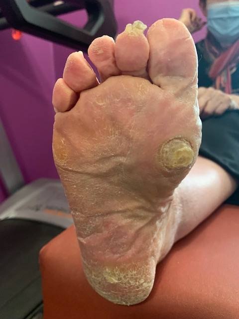 Hyperkératose hyper douloureuse sous l’avant pied et clou plantaire douloureux sous le talon – Semelles orthopédiques antalgiques fabriquées à Allauch (proche 13013 – 13012 – 13011)