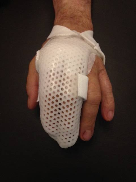 Orthèse thermoformée d'immobilisation pour protection du tendon extenseur de l'index - Allauch