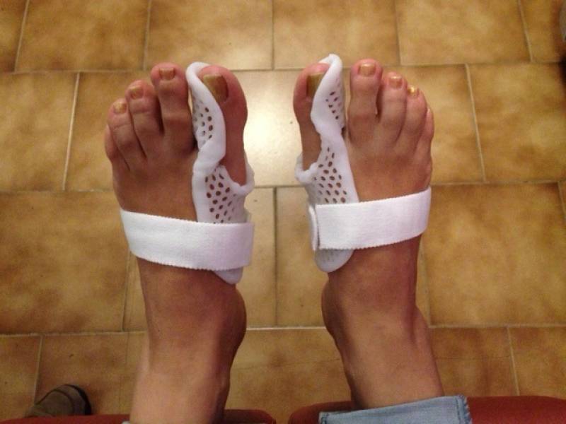Orthèses pour Hallux Valgus (oignon) sur mesure thermoformées - Marseille