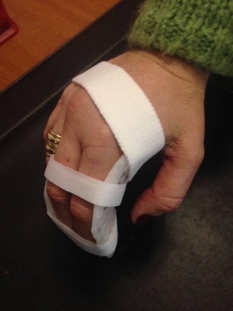 Orthèse thermoformée pour Polyarthrite Rhumatoïde - Allauch