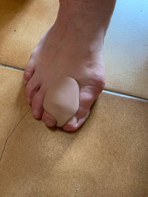 Hallux valgus ? Orthoplastie, orthèse en silicone réalisée sur mesure dans la région de Marseille