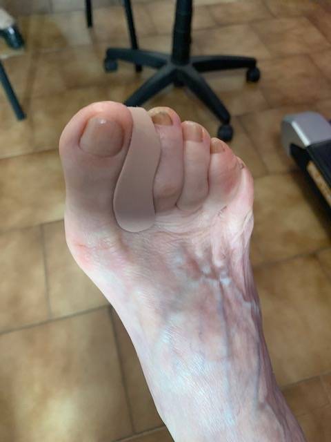 Orthoplastie pour hallux valgus : orthèse en silicone réalisée sur mesure à Allauch, proche des Olives 13013