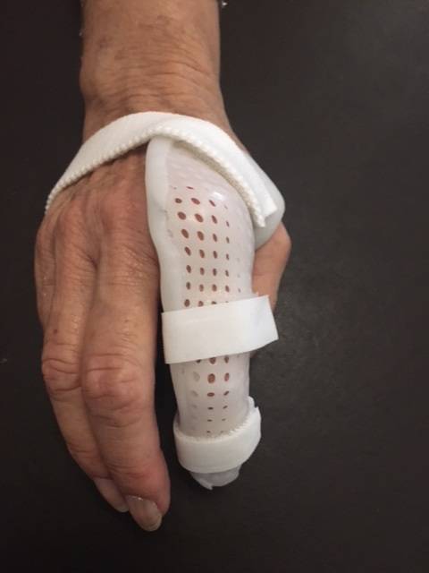 Traitement de la Polyarthrite Rhumatoïde par orthèse thermoformée de la main Allauch Plan de Cuques