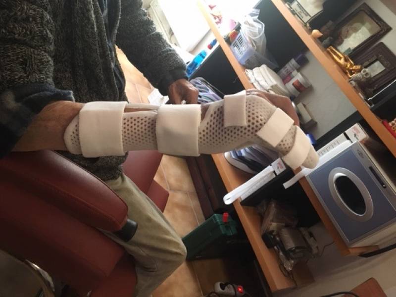 Orthèse thermoformée de type THOMINE réalisée sur mesure pour fracture du cinquième métacarpien à Allauch